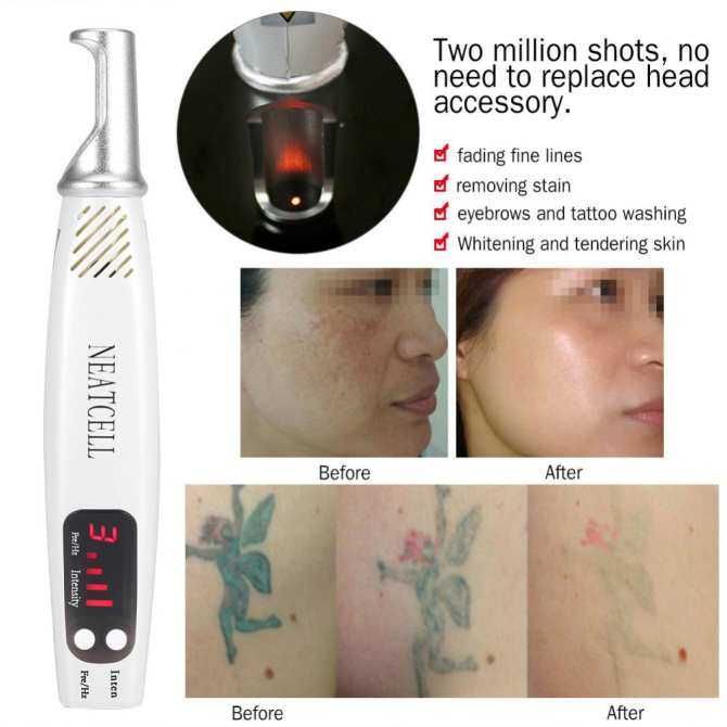 Handheald Red Light Picosecond Laser Pen Scar Tattoo Removal Melanin Dilute Device + Repair Set - intl_viptrois.com