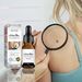 10ML Corn Removal Treatment Deep Penetration Healthy Multifunctional Skin Mole Removal Essence for Girl_viptrois.com