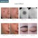 Picosecond Pen Freckle Tattoo Removal Mole Dark Spot Eyebrow Pigment Laser Acne Treatment Red Blue Light Skin Care_viptrois.com
