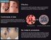 Picosecond Pen Freckle Tattoo Removal Mole Dark Spot Eyebrow Pigment Laser Acne Treatment Red Blue Light Skin Care_viptrois.com